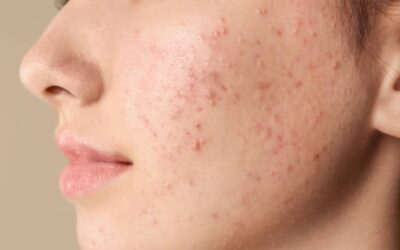 La lutte contre l’acné à l’âge adulte | Dr Lamquin | Nice
