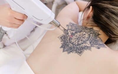 Détatouage laser